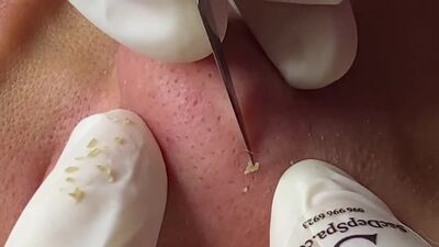 Выдавливание черных точек и забитых пор на носу