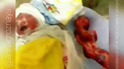 Аборт 2 и 3 триместр. Видео 1