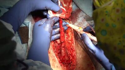 Смена пола (MtF) - Модифицированная инверсионная вагинопластика с использованием кожного лоскута мошонки и полового члена